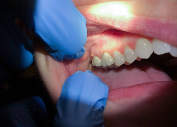 Best Emergency Dentist for Knocked-Out Tooth in Beaver, OK